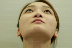 深圳广和门诊部于国东隆鼻介绍片较新分享_术后的果很好看呀！