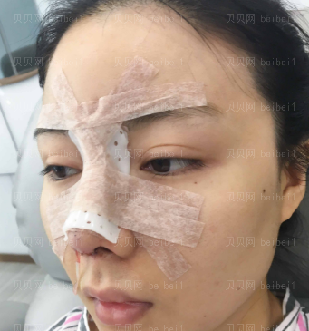 深圳广和门诊部于国东隆鼻介绍片较新分享_看到自己的鼻子，我真的很开心！