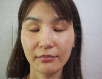 深圳美莱医疗美容整形医院曾昂双眼皮介绍片较新分享_医生的技术棒极了，瘋狂点赞