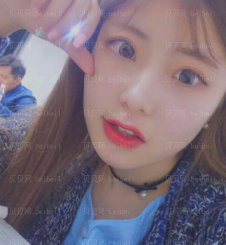 深圳美莱医疗美容整形医院何玮双眼皮介绍片较新分享_好喜欢现在的双眼皮,愈来愈漂亮了呀~