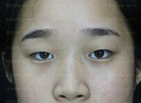 深圳美莱医疗美容整形医院官有会双眼皮介绍片较新分享_保险起见,我决定还是1个月后再化妆吧。