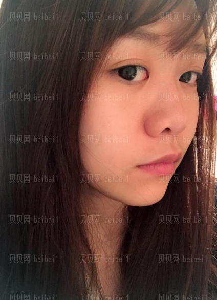 深圳博爱医院整形美容中心景熙翔鼻部综合介绍片,比之前漂亮了