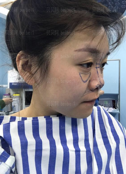 深圳博爱医院整形美容中心景熙翔鼻部综合介绍片,比之前漂亮了