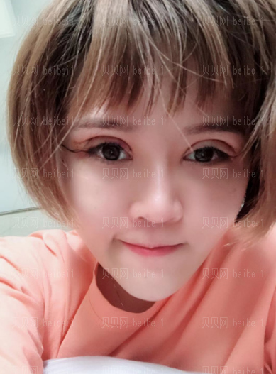  深圳博爱医院整形美容中心景熙翔平行双眼皮介绍片,多了1份娇俏感