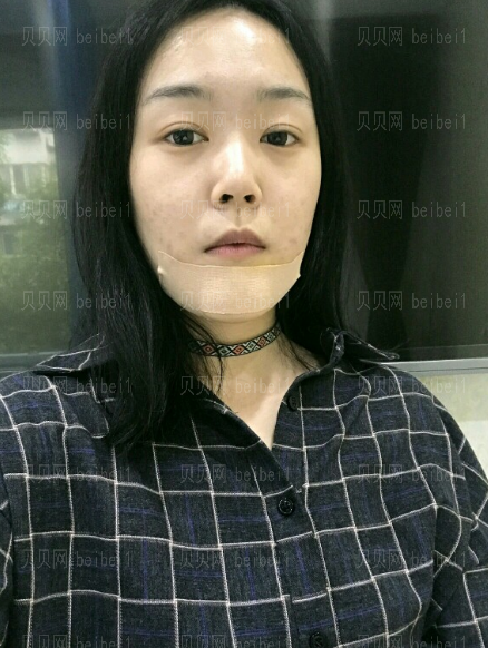 深圳博爱医院整形美容中心景熙翔垫下巴介绍片,很美腻~~~~