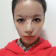 深圳美莱医疗美容整形医院肖峰肋骨隆鼻介绍片较新分享_手术后，我有做好护理工作奥！