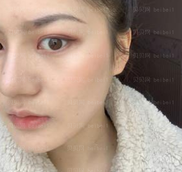 深圳美莱医疗美容整形医院林登文隆鼻介绍片较新分享 鼻子更好看啦!