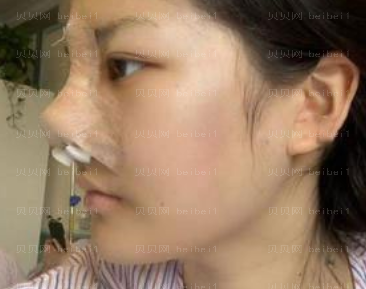 深圳美莱医疗美容整形医院林登文隆鼻介绍片较新分享 鼻子更好看啦!