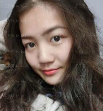 深圳美莱医疗美容整形医院林登文隆鼻介绍片较新分享 鼻子更好看啦!