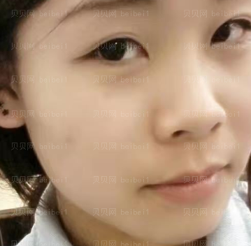 深圳美莱医疗美容整形医院林登文隆鼻介绍片较新分享_完全看不出手术的痕迹,hen令人满意~~