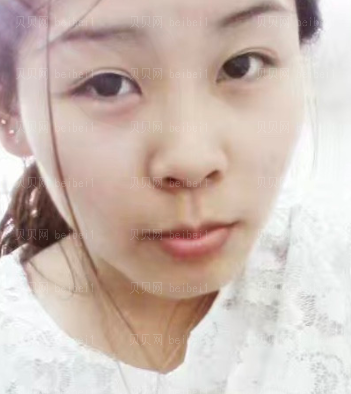 深圳美莱医疗美容整形医院林登文隆鼻介绍片较新分享_完全看不出手术的痕迹,hen令人满意~~