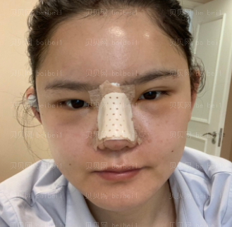 深圳美莱医疗美容整形医院周洪超鼻部整形介绍片较新分享_手术拆线了就好点了。