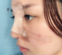 深圳美莱医疗美容整形医院尹度龙鼻修复案例图片最新分享_按照如今的恢复情况，一切都很顺利~