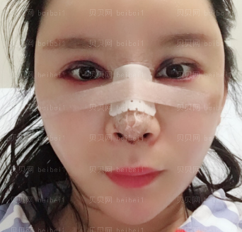 深圳美莱医疗美容整形医院尹度龙 眼鼻整形介绍片较新分享_术后果十分令人满意啦~哈哈