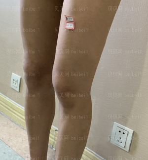 深圳美莱医疗美容医院郭杰大腿吸脂介绍片较新分享_好期待自身腿瘦几圈的模样！