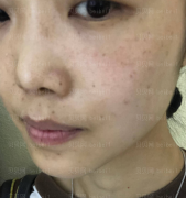 深圳美莱医疗美容整形医院杨鹏超激光美肤祛斑介绍片较新分享_斑没有啦~~