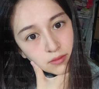 深圳美莱医疗美容整形医院杨鹏祛斑介绍片较新分享_我恢复得很好,脸部干净了,人都漂亮了许多