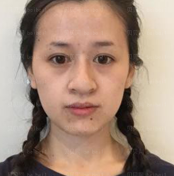 深圳美莱医疗美容整形医院杨鹏祛斑介绍片较新分享_我恢复得很好,脸部干净了,人都漂亮了许多