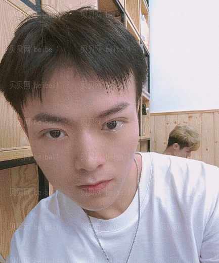 深圳妍熙医疗美容门诊部周敏全切双眼皮介绍片较新分享——感觉现在这样就像是自己天生的双眼皮了,完全不会显得很假之类的