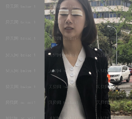 深圳美莱医疗美容医院陈磊双眼皮介绍片较新分享_眼晴讨人喜欢啊