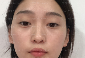 深圳美莱医疗美容医院梁志为双眼皮介绍片较新分享_走到哪里几乎都是众人的聚焦点!