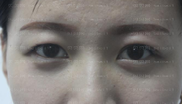 深圳美莱医疗美容医院梁志为双眼皮介绍片较新分享_看着眼晴已经变得越来越好了，真的是激动呢！