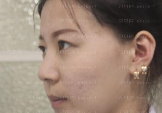 深圳美莱医疗美容医院梁志为双眼皮介绍片较新分享_看着眼晴已经变得越来越好了，真的是激动呢！