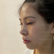深圳美莱医疗美容整形医院杨霞祛斑介绍片较新分享_近就只能吃清淡的東西啦~