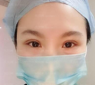 深圳美莱医疗美容医院李战强双眼皮介绍片较新分享_恢复的这么好也是预料之中的事情。