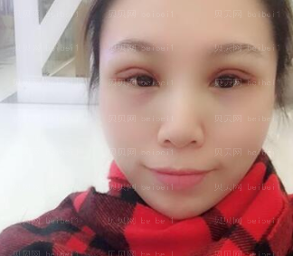 深圳美莱医疗美容医院李战强双眼皮介绍片较新分享_恢复的这么好也是预料之中的事情。
