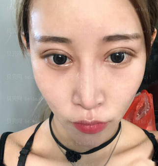 深圳美莱医疗美容医院李战强眼修复介绍片较新分享_骨感与美感還是要兼在的。