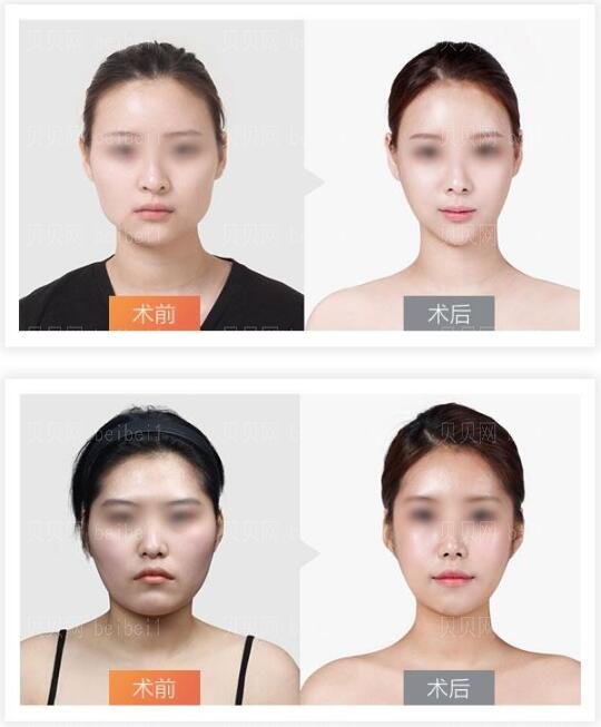颧骨磨骨整形疼痛感怎么样呢?痛吗?术后要怎么样护理呢