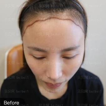 广州新生植发怎么样？看发际线改良手术介绍