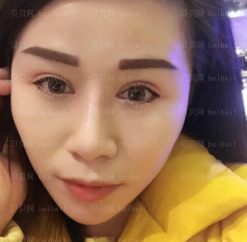 深圳美莱医疗美容整形医院徐占锋双眼皮介绍片较新分享_都说感觉较为好看哈哈