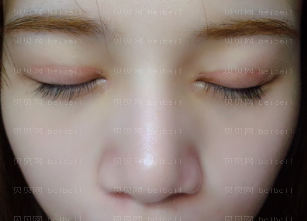 深圳丽港丽格医疗美容医院谢俊双眼皮介绍片较新分享_好想快点儿消肿啊