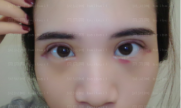 深圳丽港丽格医疗美容医院谢俊双眼皮介绍片较新分享_好想快点儿消肿啊