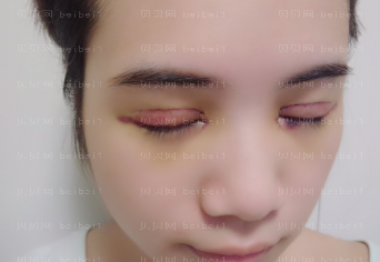 深圳丽港丽格医疗美容医院谢俊双眼皮介绍片较新分享_好想快点儿消肿啊