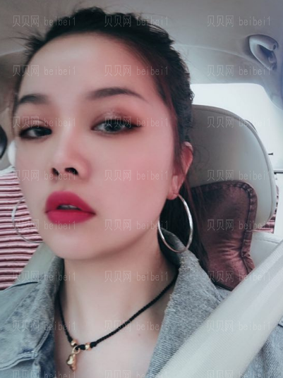 深圳伊婉医疗美容门诊部崔军双眼皮介绍片较新分享——眼睛看着越来越有神了