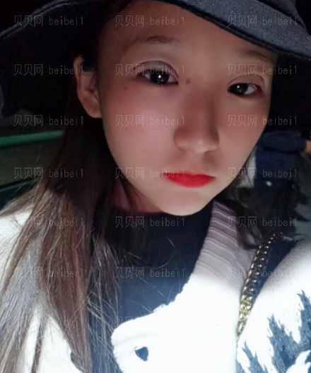 深圳伊婉医疗美容门诊部严友才双眼皮介绍片较新分享——现在恢复得特别好