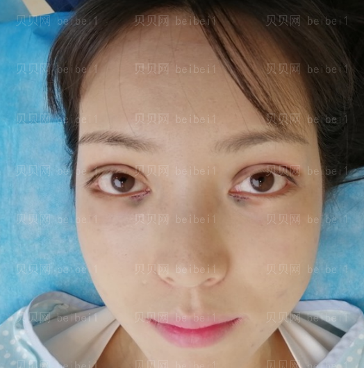 深圳伊婉医疗美容门诊部严友才双眼皮+开眼角介绍片较新分享——真的是一天一个样子,越来越自然了