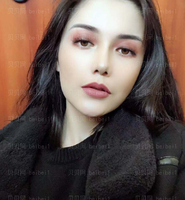 深圳伊婉医疗美容门诊部严友才垫鼻基底介绍片较新分享——已经完全恢复了哦