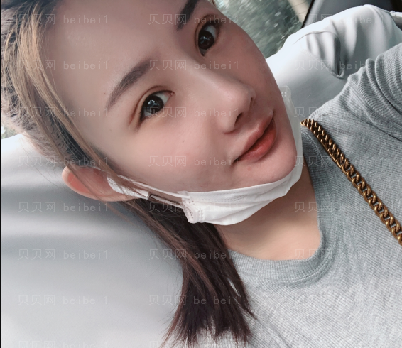 深圳易容颜医疗美容门诊部焦广银双眼皮+隆鼻介绍片较新分享——恢复果挺好,现在超喜欢我的芭比电眼和小翘鼻