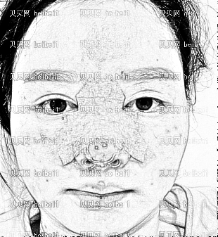 深圳睿京医疗美容整形医院王海半助隆鼻介绍片医生手法好好啊