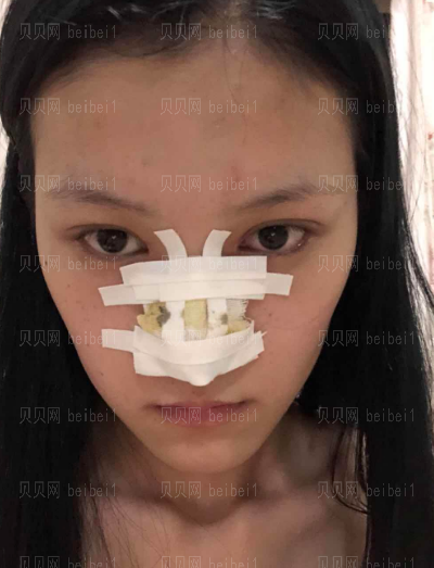 深圳阳光整形美容医院陈瑞红肋软骨隆鼻介绍片较新分享——现在的鼻子,侧面看果特别的明X,形态和弧度都很好看