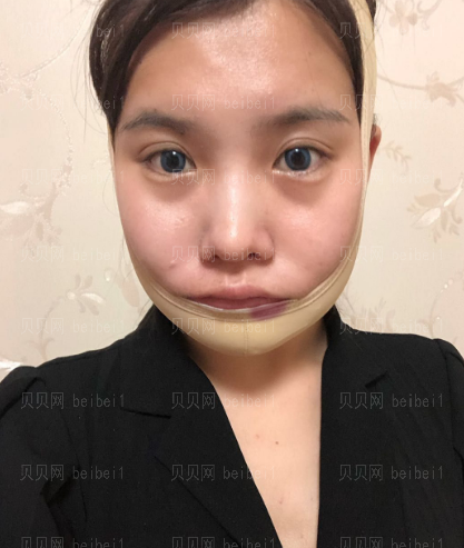 深圳阳光整形美容医院陈瑞红v-line瓜子脸介绍片较新分享——感觉恢复的很快,并且果也是较为自然的