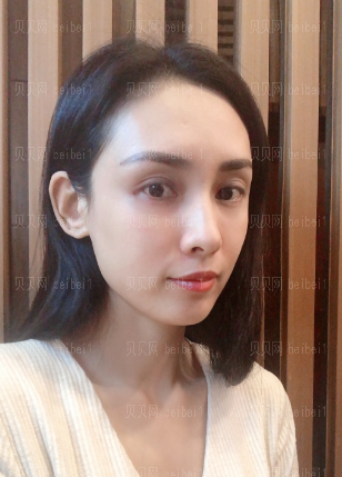 深圳阳光整形美容医院陈星光埋线提升介绍片较新分享——这段时间面部提升的果较为的明X了，即使是素颜也依然美美的