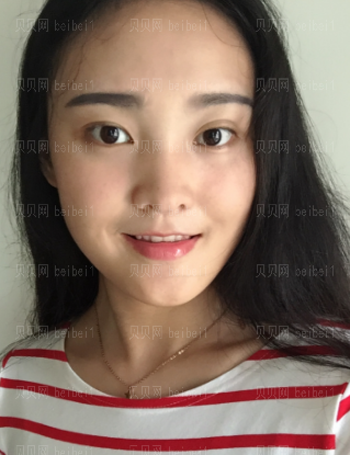 深圳阳光整形美容医院江凤娟激光去雀斑介绍片较新分享——果很棒，自从祛斑以后每天都是好心情，自信满满