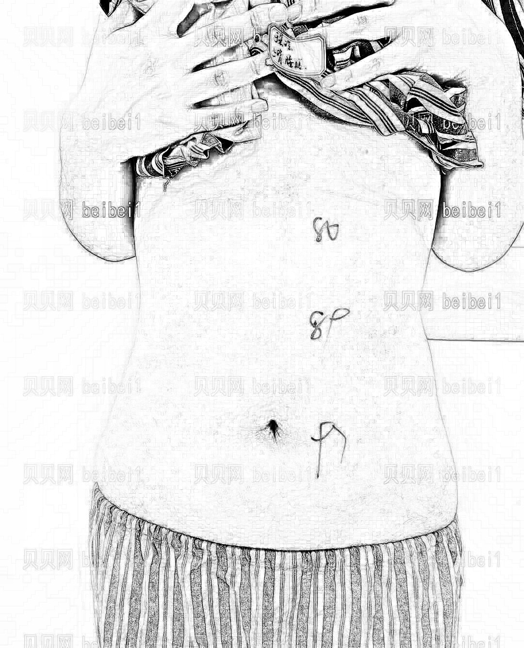 深圳非凡医疗美容医院梅够明腰腹吸脂~做完吸脂拥有小蛮腰