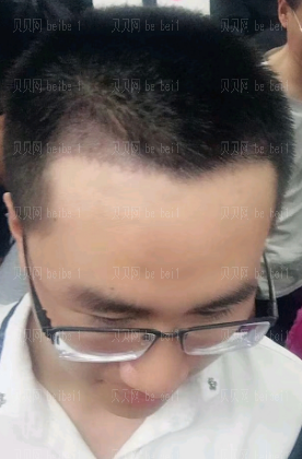 深圳阳光整形美容医院李海燕种植发际线介绍片较新分享——头发终于长出来了1厘米