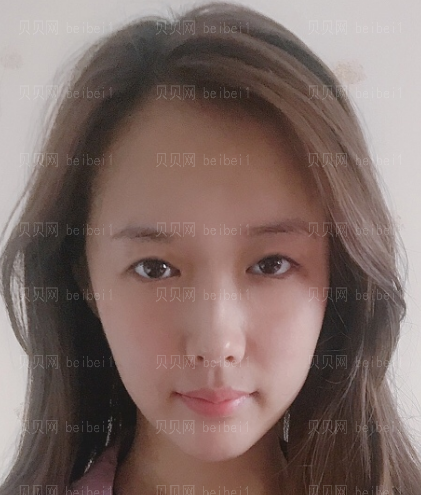 深圳阳光整形美容医院埋线双眼皮介绍片较新分享——做完眼睛已经一个多月了,感觉恢复的很好呢